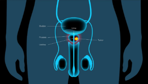 Técnicas disponiveis para o tratamento da Hiperplasia