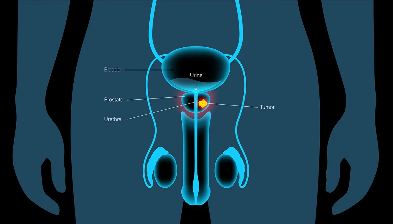 Técnicas disponiveis para o tratamento da Hiperplasia
