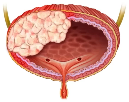 ilustracao-da-ocorrencia-de-cancer-de-bexiga