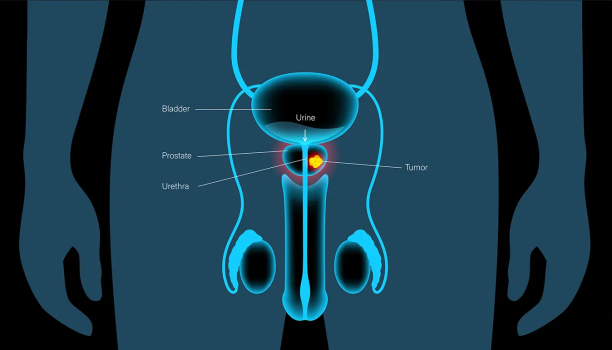 Técnicas disponiveis para o tratamento da Hiperplasia